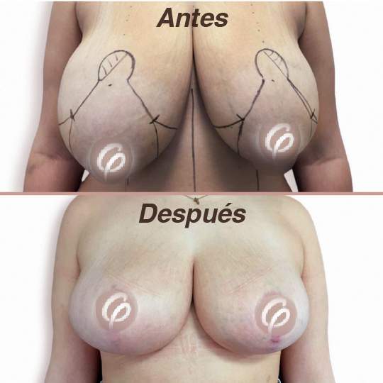 antes y despues-04