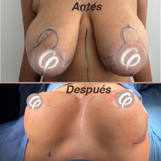antes y despues-08