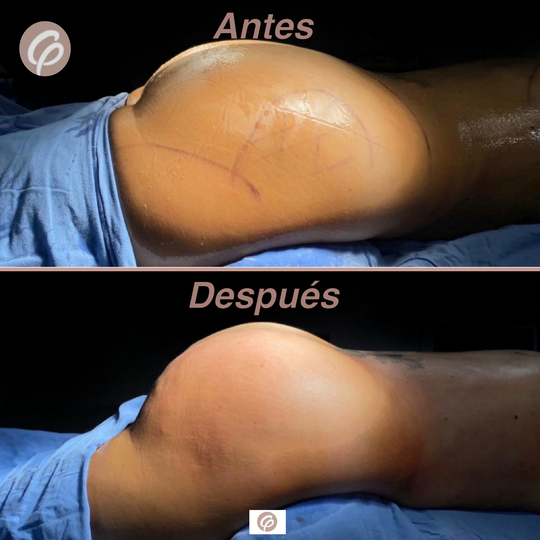 antes y despues