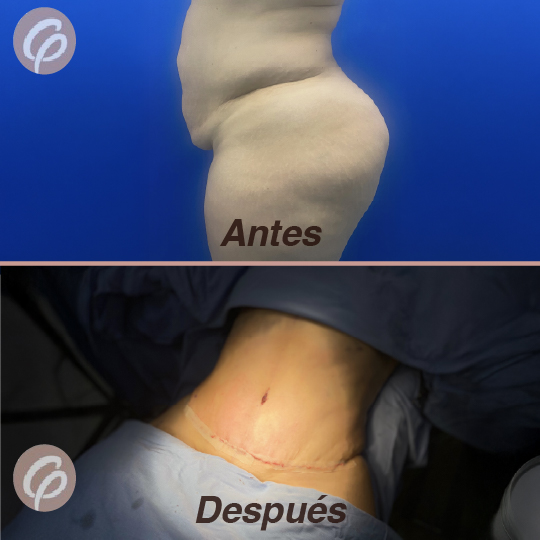 antes y despues-12