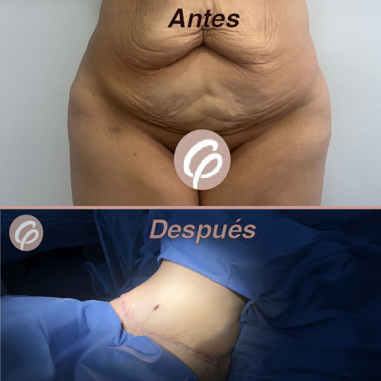 antes y despues-13