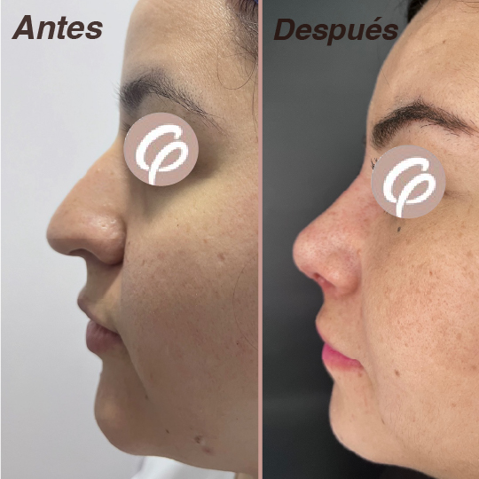 antes y despues-14