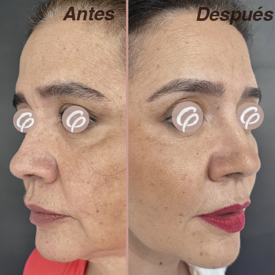 antes y despues-17