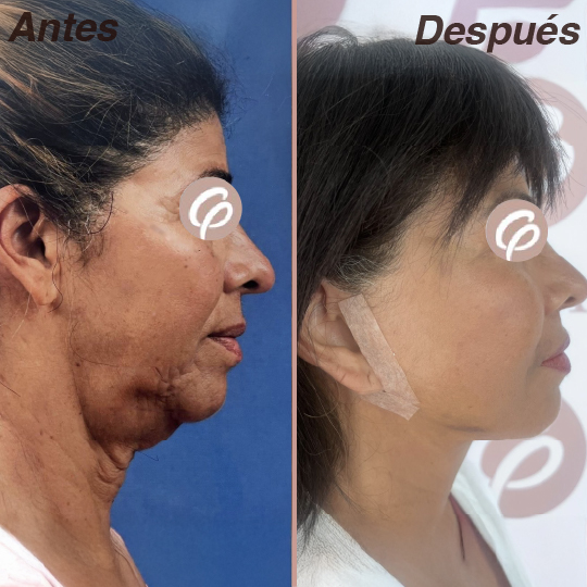 antes y despues-20