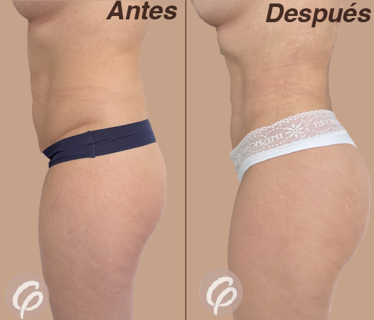 antes y despues-21