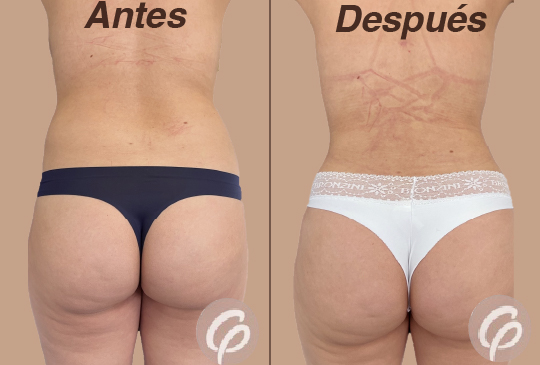 antes y despues-22