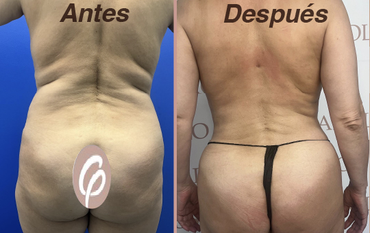antes y despues-23