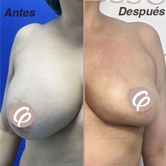 antes y despues-25