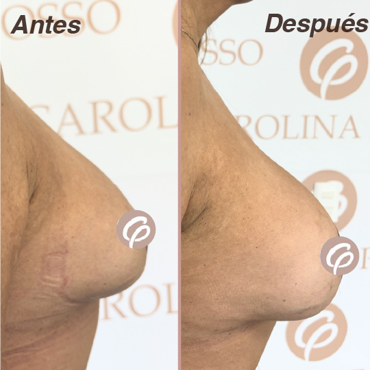 antes y despues-26