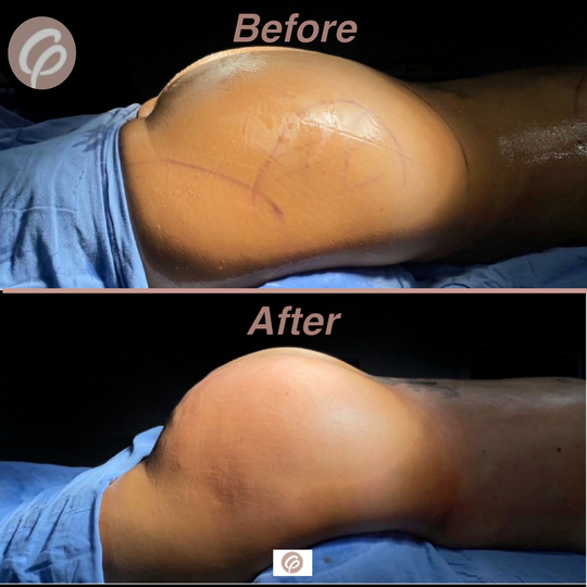 before and after_2_2