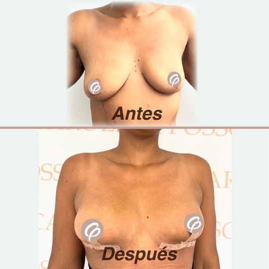 antes despues - Lipotransferencia en senos y maxtopexia