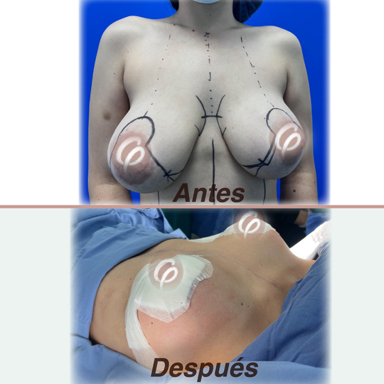 antes y despues - Mastopexia con implantes