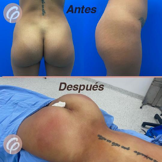 antes y despues - gluteoplastia con lipotransferencia (2)