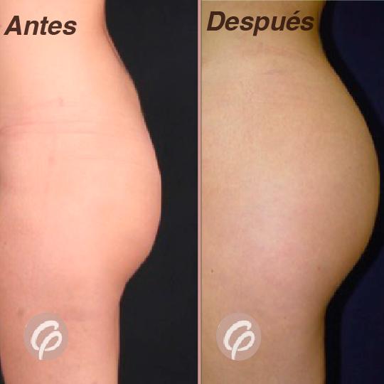 antes y despues - gluteoplastia con lipotransferencia