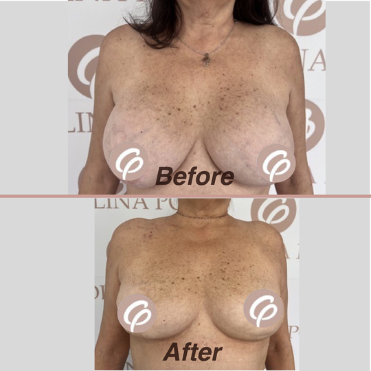 before and after-Explantation with reconstruction personal technique540X540