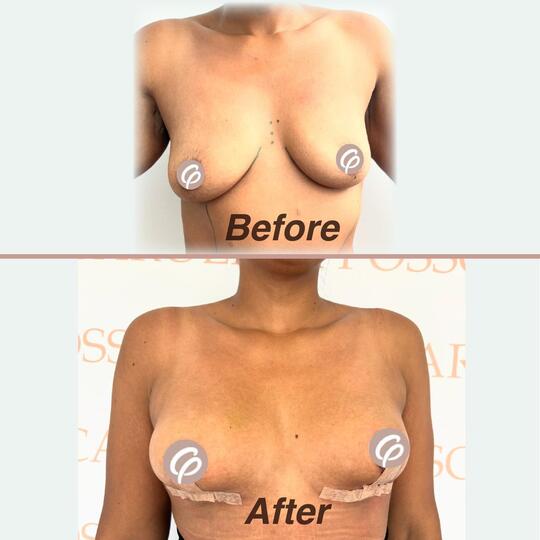 before and after - Lipotransfer to breasts and maxtopexy