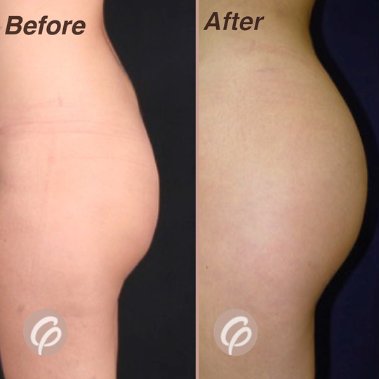 before and after-gluteoplasty with lipotransfer (2)