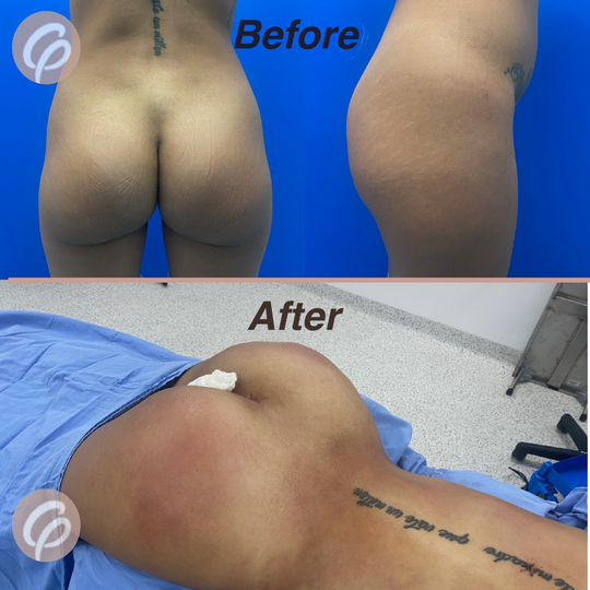 before and after-gluteoplasty with lipotransfer